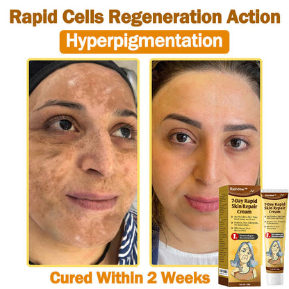 Raindew™ 7-Day Rapid Skin Repair Cream Approved by dermatologists (BfArM recommended)𝐒 𝐃𝐞𝐫𝐦𝐚𝐭𝐨𝐥𝐨𝐠𝐢𝐬𝐭 𝐀𝐩𝐩𝐫𝐨𝐯𝐞𝐝(💞💞𝐀𝐀𝐃 𝐑𝐄𝐂𝐎𝐌𝐌𝐄𝐍𝐃𝐒)