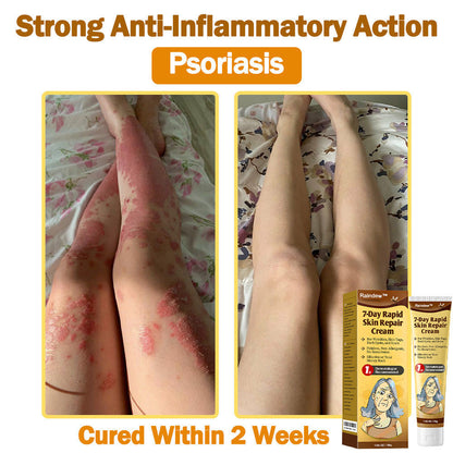 Raindew™ 7-Day Rapid Skin Repair Cream Approved by dermatologists (BfArM recommended)𝐒 𝐃𝐞𝐫𝐦𝐚𝐭𝐨𝐥𝐨𝐠𝐢𝐬𝐭 𝐀𝐩𝐩𝐫𝐨𝐯𝐞𝐝(💞💞𝐀𝐀𝐃 𝐑𝐄𝐂𝐎𝐌𝐌𝐄𝐍𝐃𝐒)