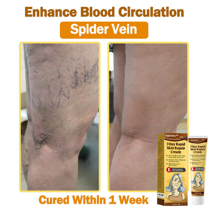 Raindew™ 7-Day Rapid Skin Repair Cream Approved by dermatologists (BfArM recommended)𝐒 𝐃𝐞𝐫𝐦𝐚𝐭𝐨𝐥𝐨𝐠𝐢𝐬𝐭 𝐀𝐩𝐩𝐫𝐨𝐯𝐞𝐝(💞💞𝐀𝐀𝐃 𝐑𝐄𝐂𝐎𝐌𝐌𝐄𝐍𝐃𝐒)