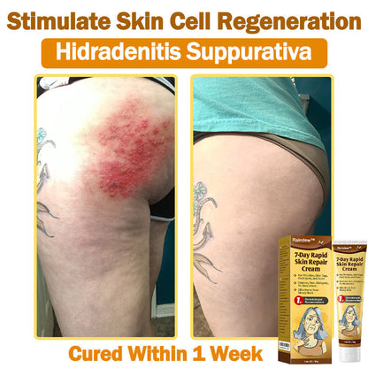 Raindew™ 7-Day Rapid Skin Repair Cream Approved by dermatologists (BfArM recommended)𝐒 𝐃𝐞𝐫𝐦𝐚𝐭𝐨𝐥𝐨𝐠𝐢𝐬𝐭 𝐀𝐩𝐩𝐫𝐨𝐯𝐞𝐝(💞💞𝐀𝐀𝐃 𝐑𝐄𝐂𝐎𝐌𝐌𝐄𝐍𝐃𝐒)
