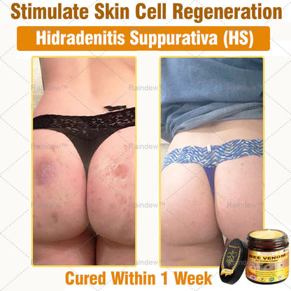 Oxford University Hospital Dermatology Recommendations | Official Store | Raindew® Bee Venom Repair Cream: Anti-aging, Hydrating, Skin Repair, Even Tone, Acne and Dark Spot Treatment, Wart and Mole Removal, Psoriasis Relief.(MHRA approved)